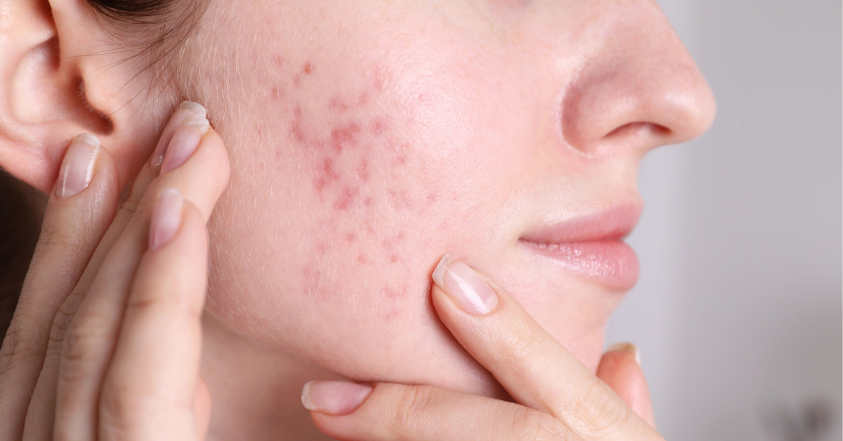 Cómo detener el acné de la perimenopausia