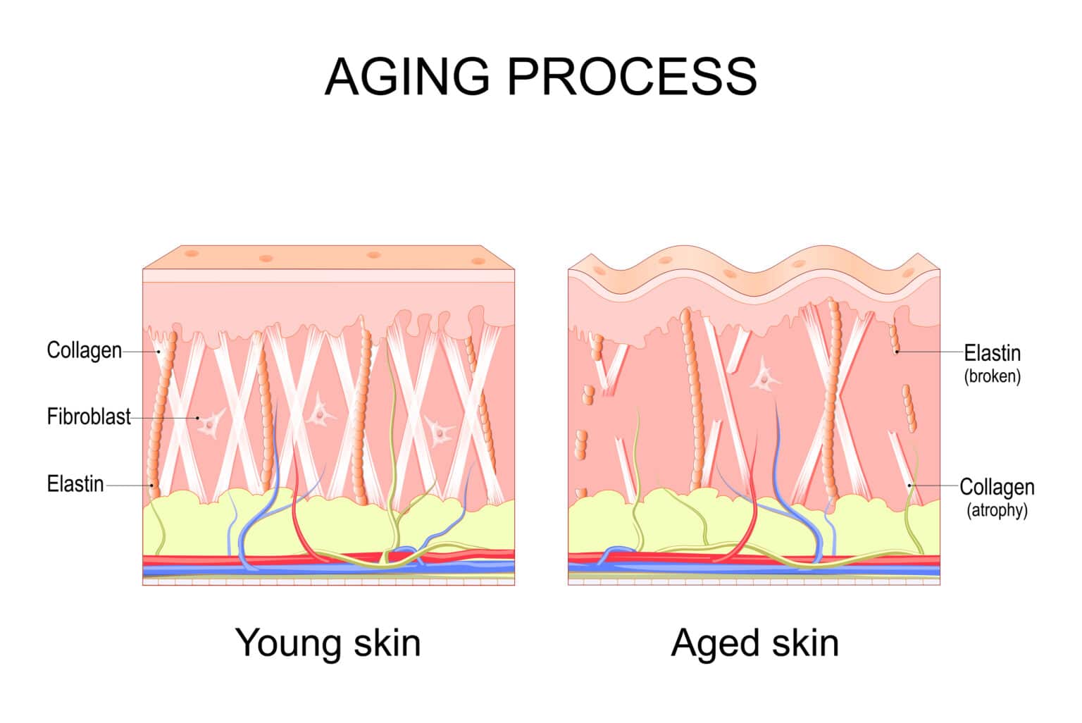 What happens to your skin at menopause: a comparison of Young and aged skin. Collagen, Elastin and fibroblasts in younger and older skin. age-related changes in the skin when Collagen fibers atrophy, and Elastin broken. Vector illustration